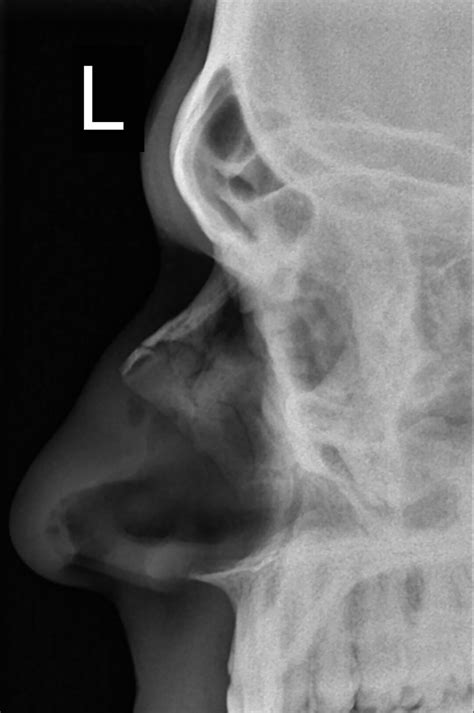 nose stl x ray meaning|Xray Examination of the Nasal Bone .